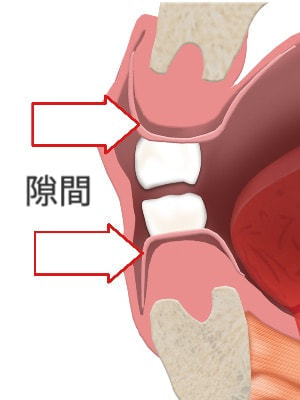 入れ歯の隙間