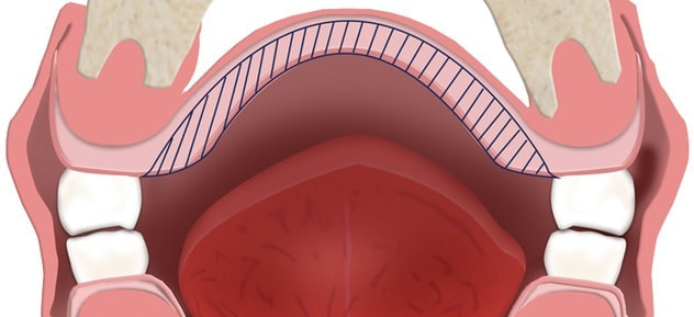 リベース1