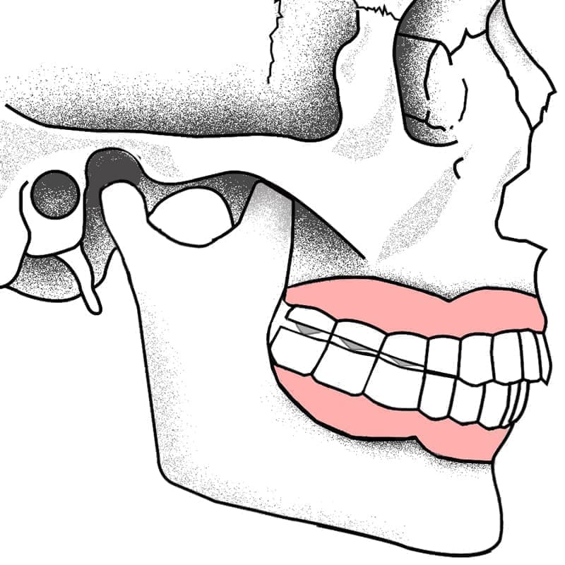 顎関節のズレと入れ歯