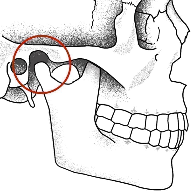 顎関節のズレ
